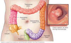 Bowel Cancer Sydney Surgeon