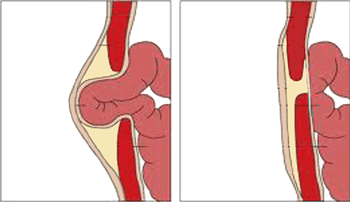 Hernia Surgery Sydney Surgery inguinal femoral direct indirect