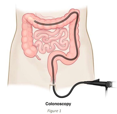 Colonoscopy, Sydney Surgeon, PR Bleeding, FOBT