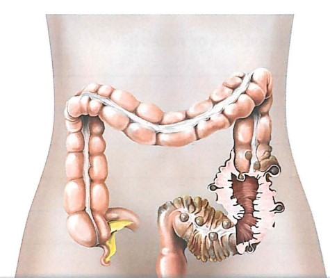 Diverticulitis Dr Golani Surgery Sydney Surgeon
