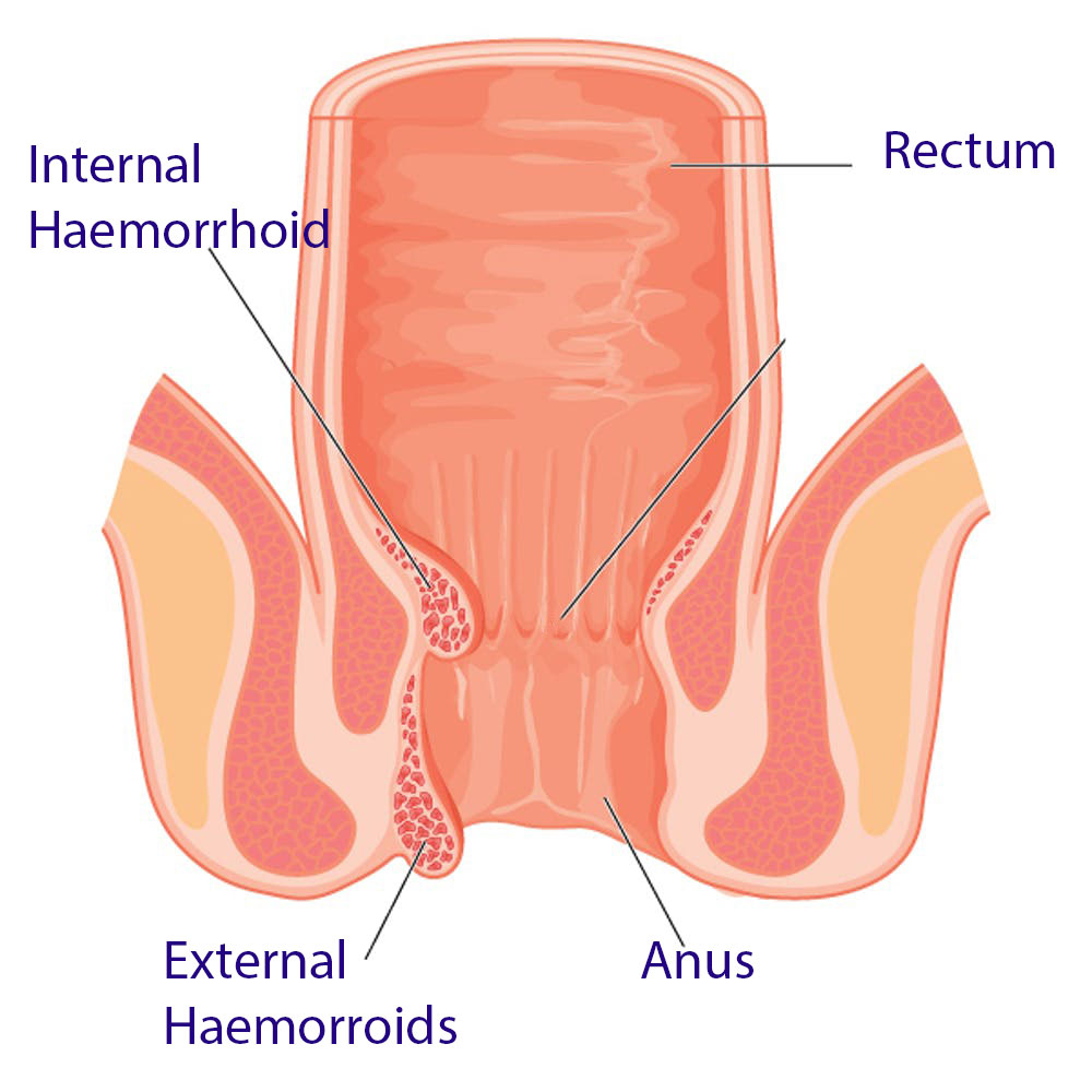 Haemorroids-Surgery-Treatment-Sydney