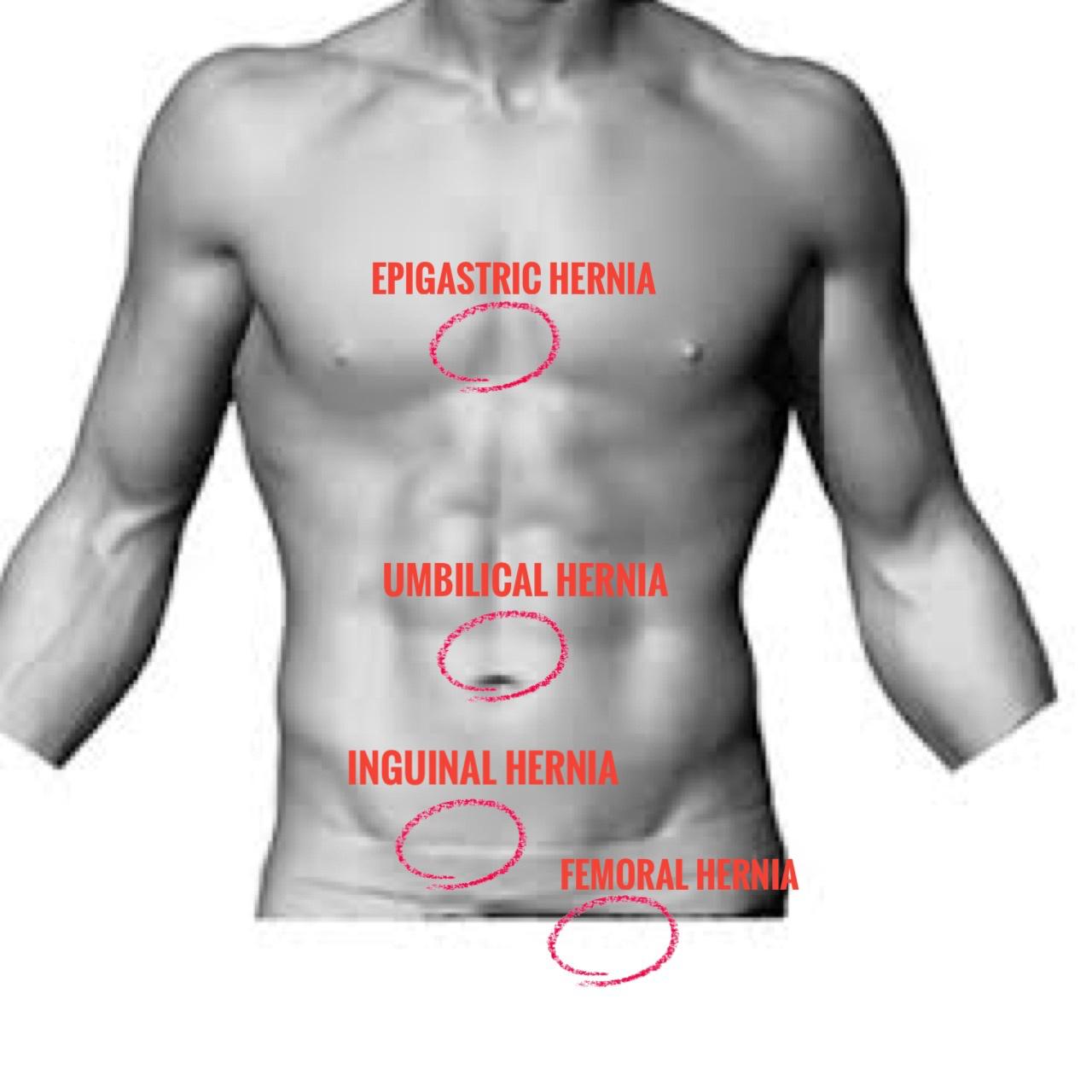 Hernia Surgery Sydney Surgery inguinal femoral direct indirect