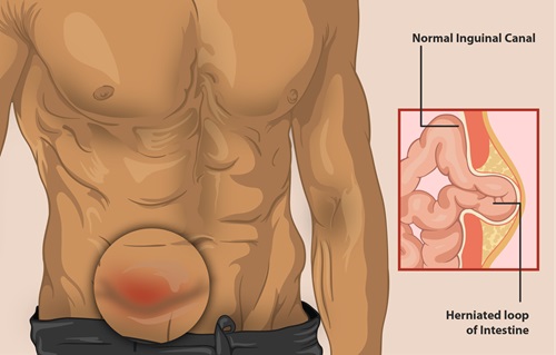 Hernia Surgery Sydney Surgery inguinal femoral direct indirect