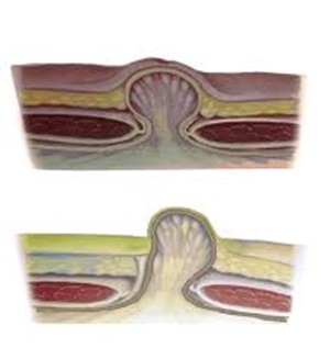 Hernia Surgery Sydney Surgery inguinal femoral direct indirect