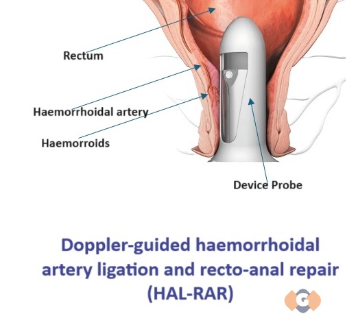 Surgery by Dr Golani for Haemorrhoids(hal-rar) a new technique