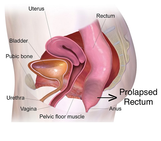 Surgery Dr Golani Rectal Prolapse Repair